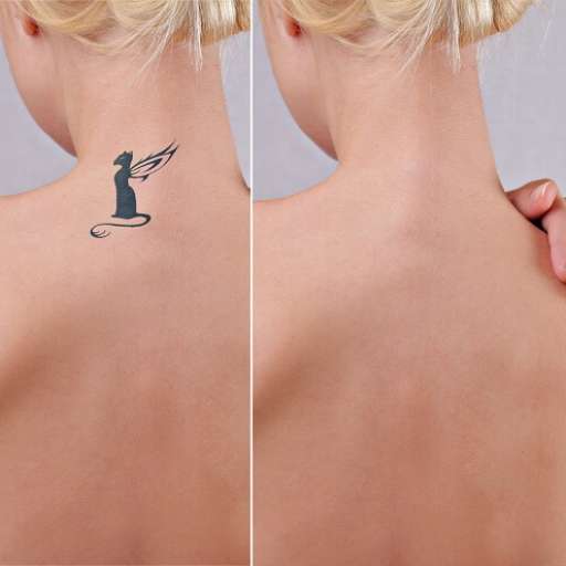 Xóa xăm thẩm mỹ